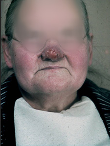 Lupus vulgaris